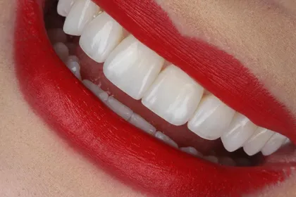 Sorriso com restaurações anteriores em resina composta